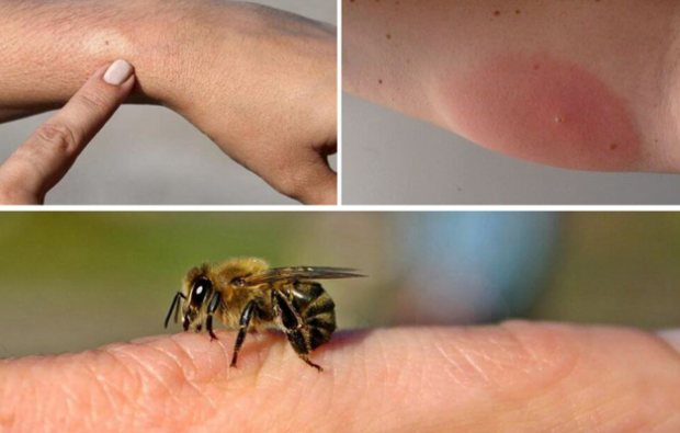 mehiläisten allergiaoireet