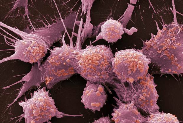 Mikä on syöpä ja mitkä ovat sen oireet? Kuinka monta syöpätyyppiä on? Kuinka syöpä estetään?