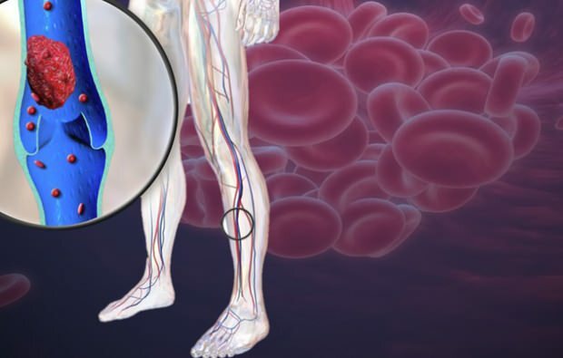vähentynyt verenkierto jalkasuoneissa aiheuttaa kipua